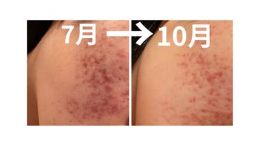 大人のニキビ対策 薬用美白化粧水/肌美精/化粧水を使ったクチコミ（2枚目）