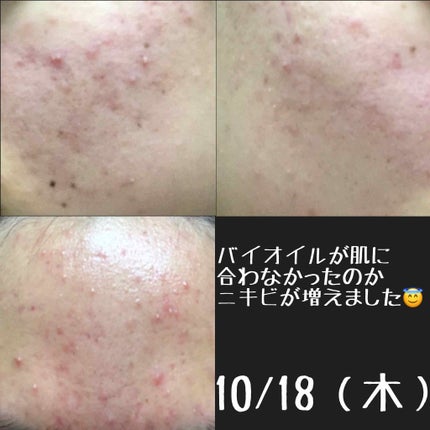 バイオイル/バイオイル/フェイスオイルを使ったクチコミ(3枚目)