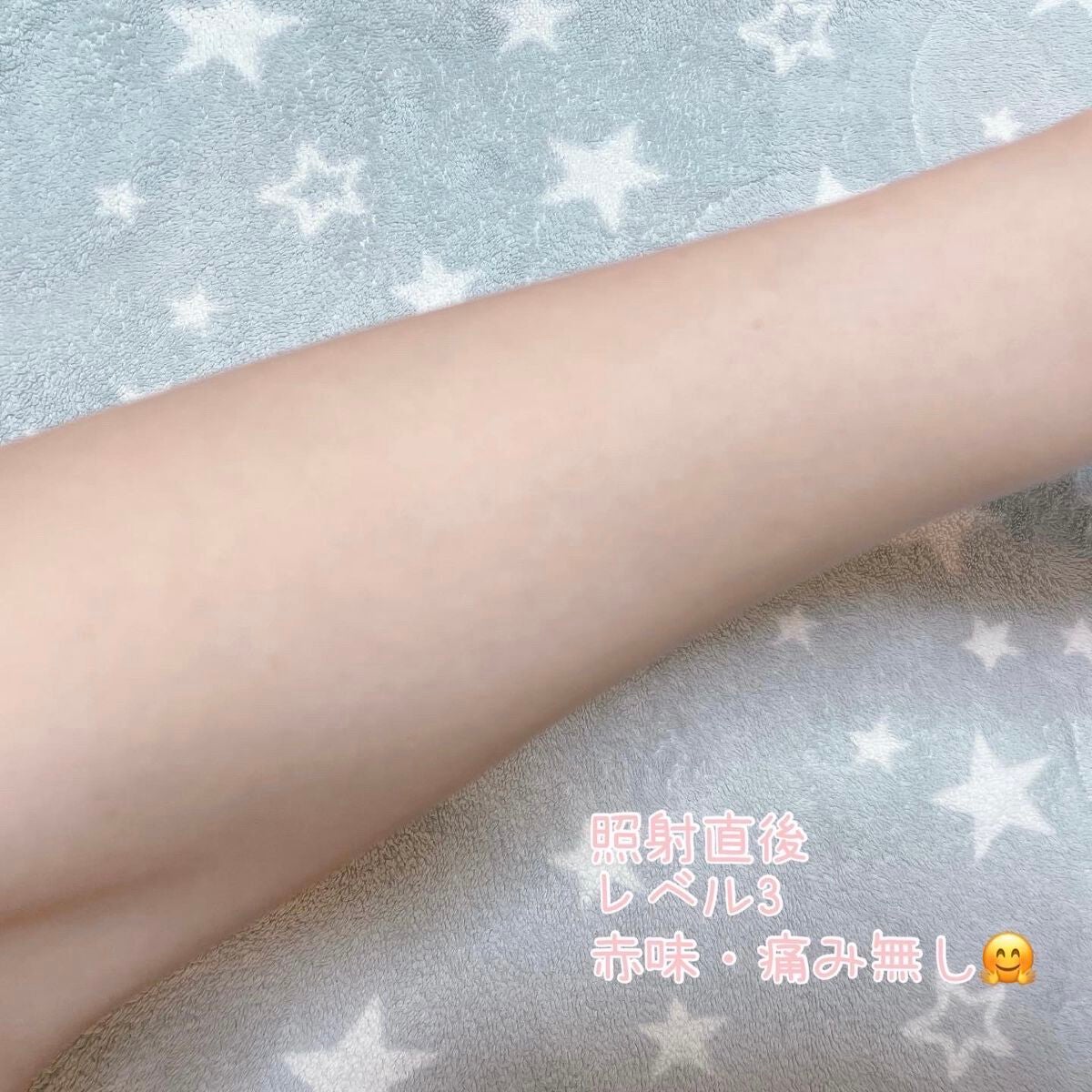 サファイヤIPL光脱毛器/NiZmir/家庭用脱毛器を使ったクチコミ(5枚目)