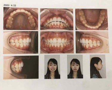 ひっそりねぎ on LIPS 「2ページ目から私の・顔(加工無し)・口の中の写真があります。顔..」（4枚目）