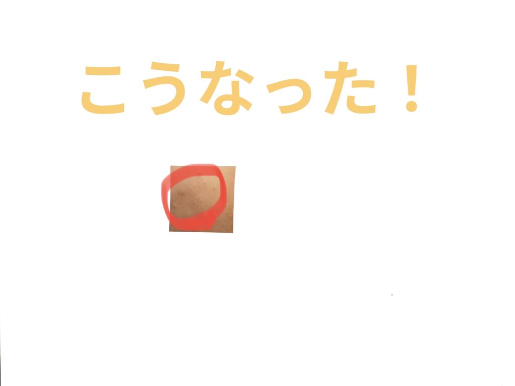 EUKROMA　ハイドロキノンクリーム4%　20g/EUKROMA/その他スキンケアを使ったクチコミ（3枚目）