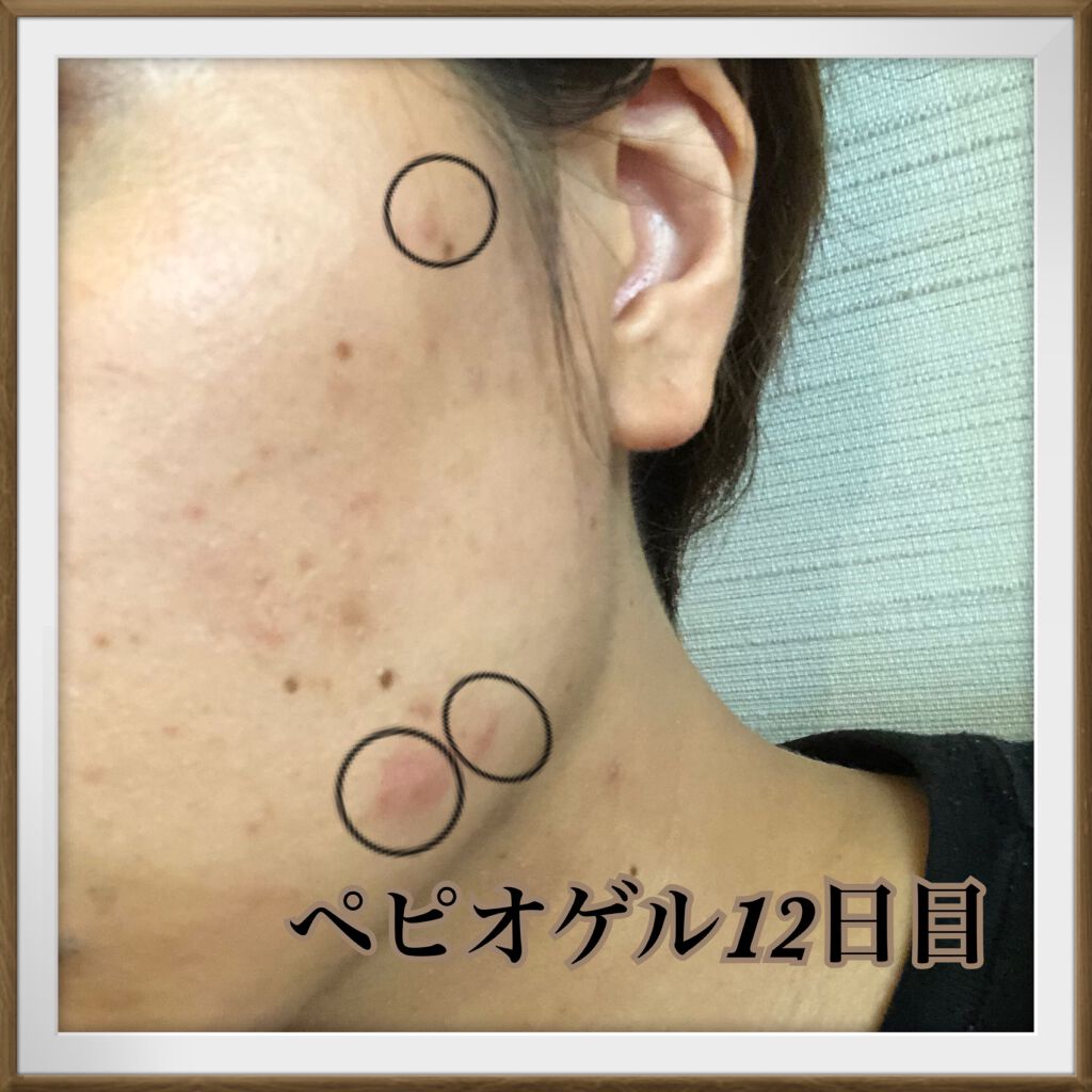 りんにゃ~フォロバ100🙆🏼♀️~🔰 on LIPS 「✍️肌荒れ奮闘記✍️こんにちは´`*りんにゃです!#ベピオゲル..」(1枚目)