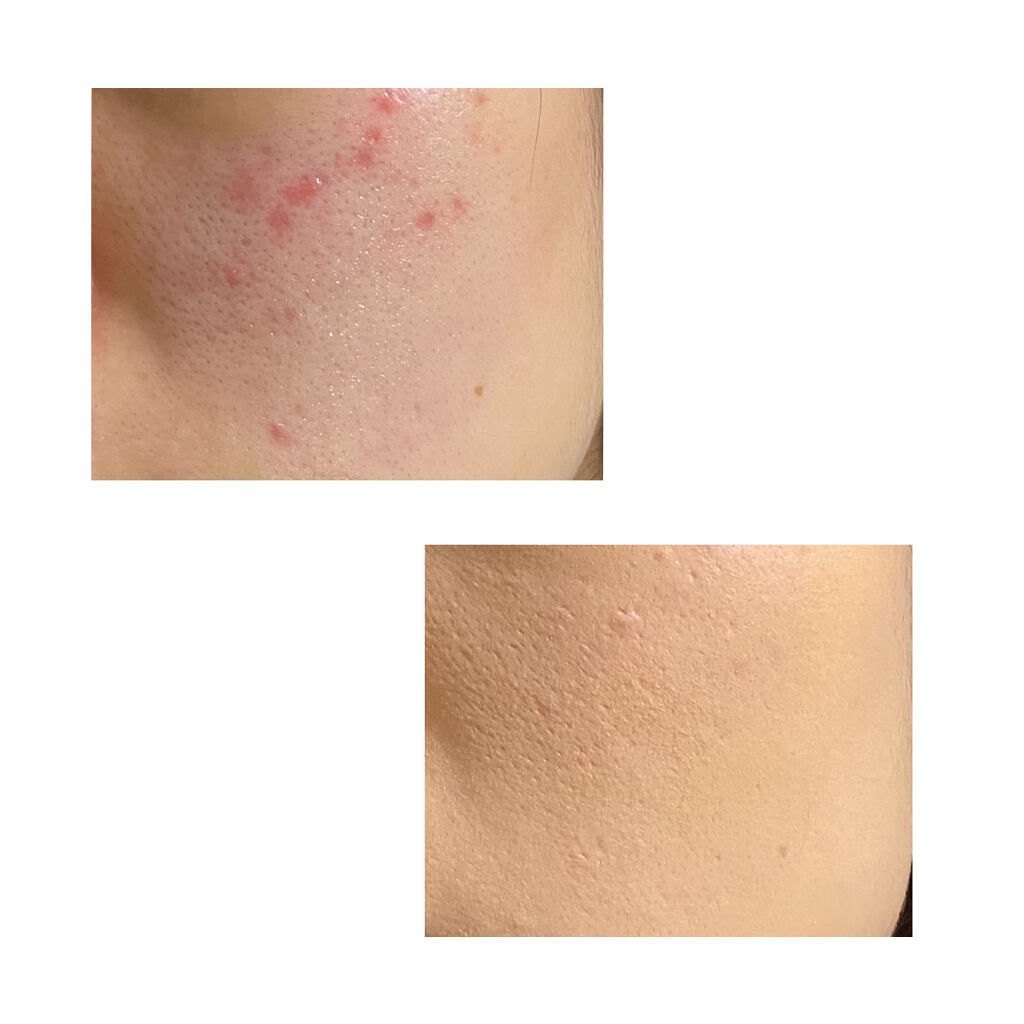 ラディアントクリーミーコンシーラー/NARS/リキッドコンシーラーを使ったクチコミ（3枚目）