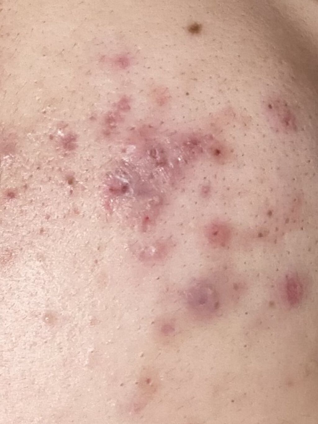 エピデュオゲル/美容皮膚科/フェイスクリームを使ったクチコミ（1枚目）