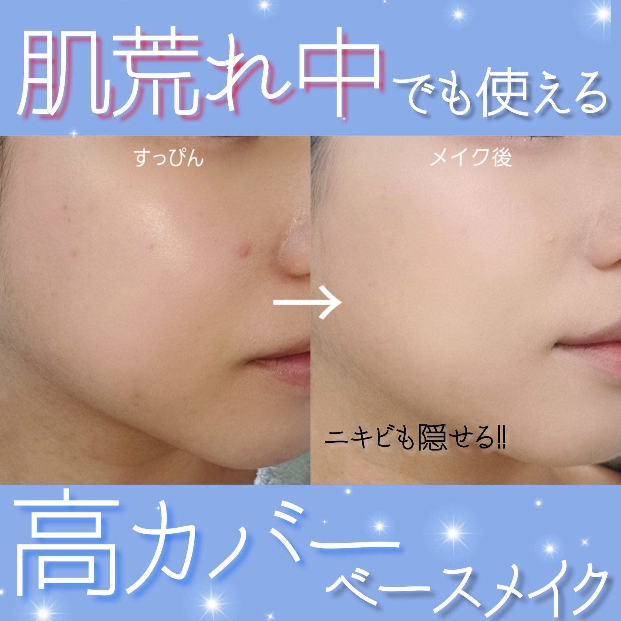 薬用コンシーラー アクネプロテクター/ONLY MINERALS/パウダーコンシーラーを使ったクチコミ（1枚目）