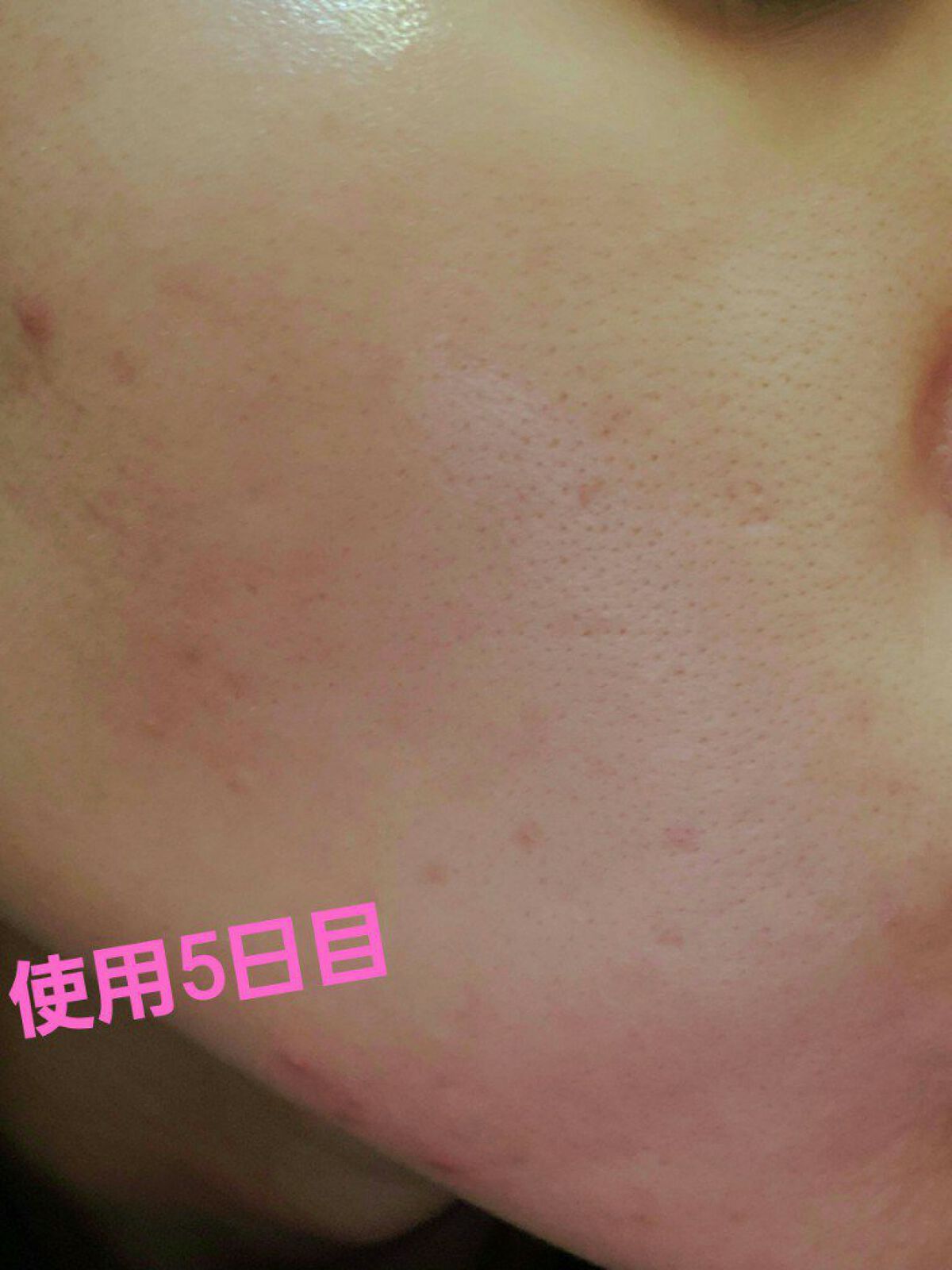 C25セラム ネオ/オバジ/美容液を使ったクチコミ（3枚目）