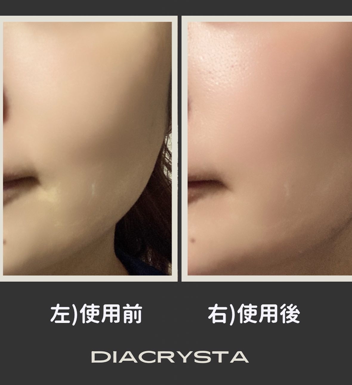 diacrysta 美顔器/diacrysta/美顔器・マッサージを使ったクチコミ(10枚目)