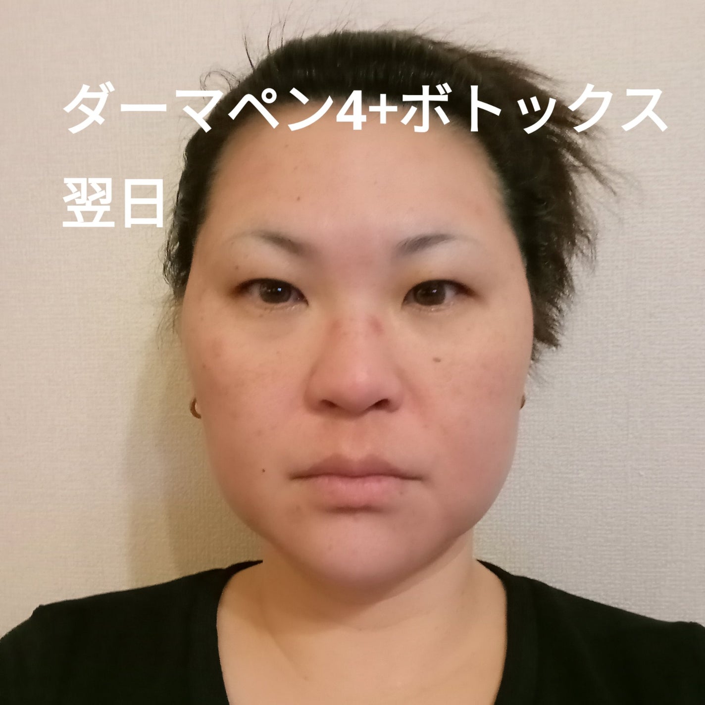 ビヨンセ奥二重向上委員長🥸LIPSパートナー🥳 on LIPS 「ダーマペン4+ボトックス翌日の状態です!赤みはだいぶ引いてきた..」(1枚目)