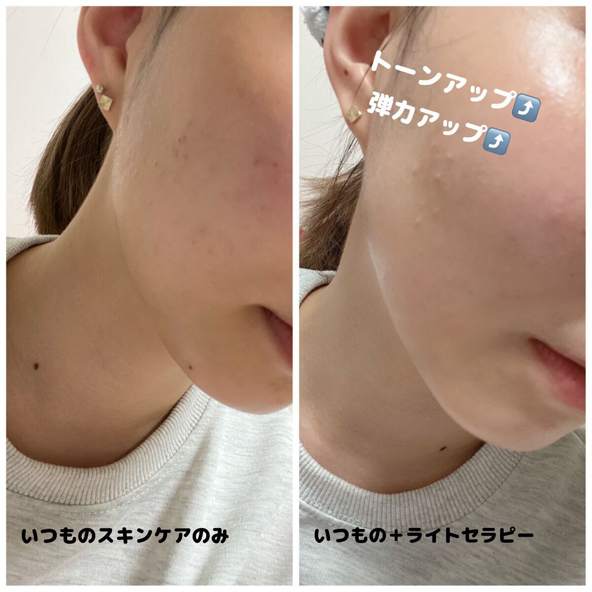 スキンライトセラピーII/Makeon/美顔器・マッサージを使ったクチコミ(4枚目)