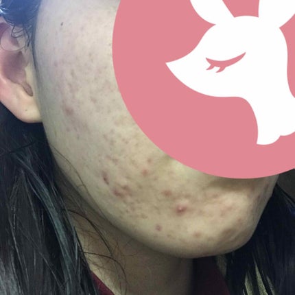 miina@汚肌工事録⚠️ on LIPS 「肌をきれいにするための自分用記録です✏️#汚肌工事録※汚い写真..」(4枚目)