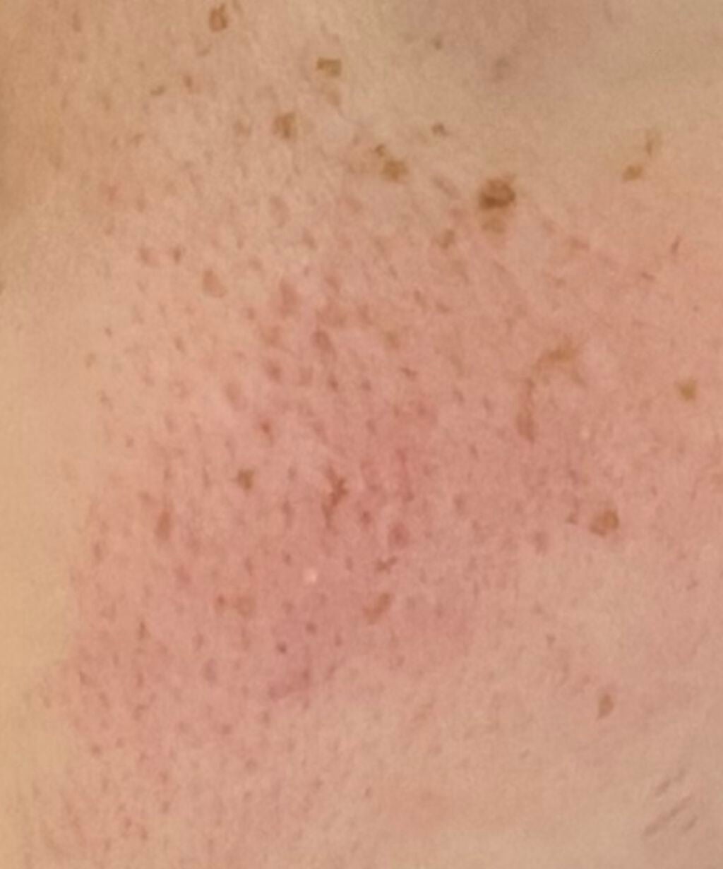 (⸝⸝o̴̶̷᷄ o̴̶̷̥᷅⸝⸝)✌️🏻 on LIPS 「頬の赤みと毛穴が目立つことに悩んでます少しでもマシにしたいので..」(2枚目)