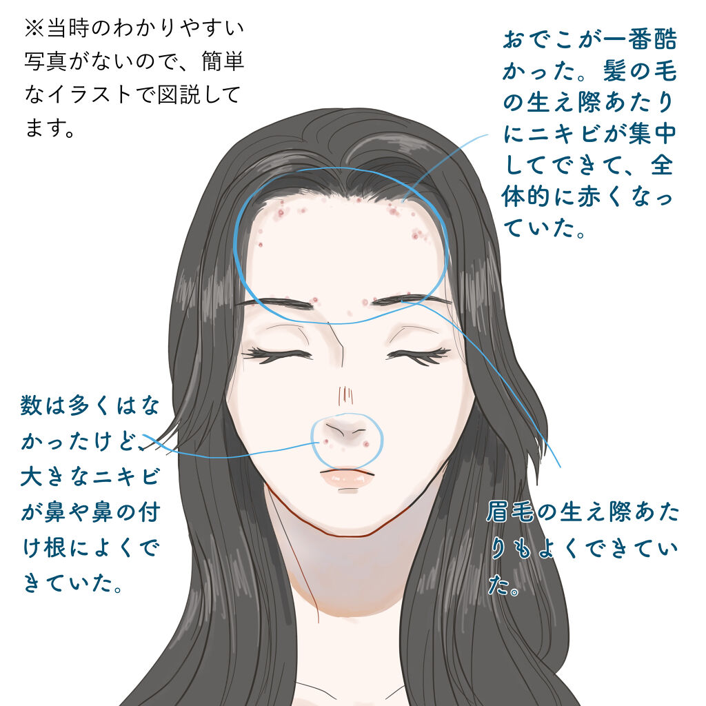 潤浸保湿 化粧水 III とてもしっとり/キュレル/化粧水を使ったクチコミ（2枚目）