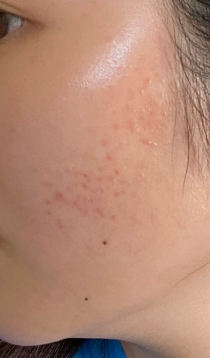 薬用しみ集中対策 プレミアム美容液/メラノCC/美容液を使ったクチコミ(4枚目)