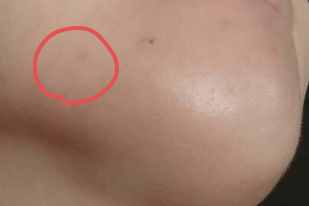 オロナインＨ軟膏 (医薬品)/オロナイン/その他を使ったクチコミ（3枚目）