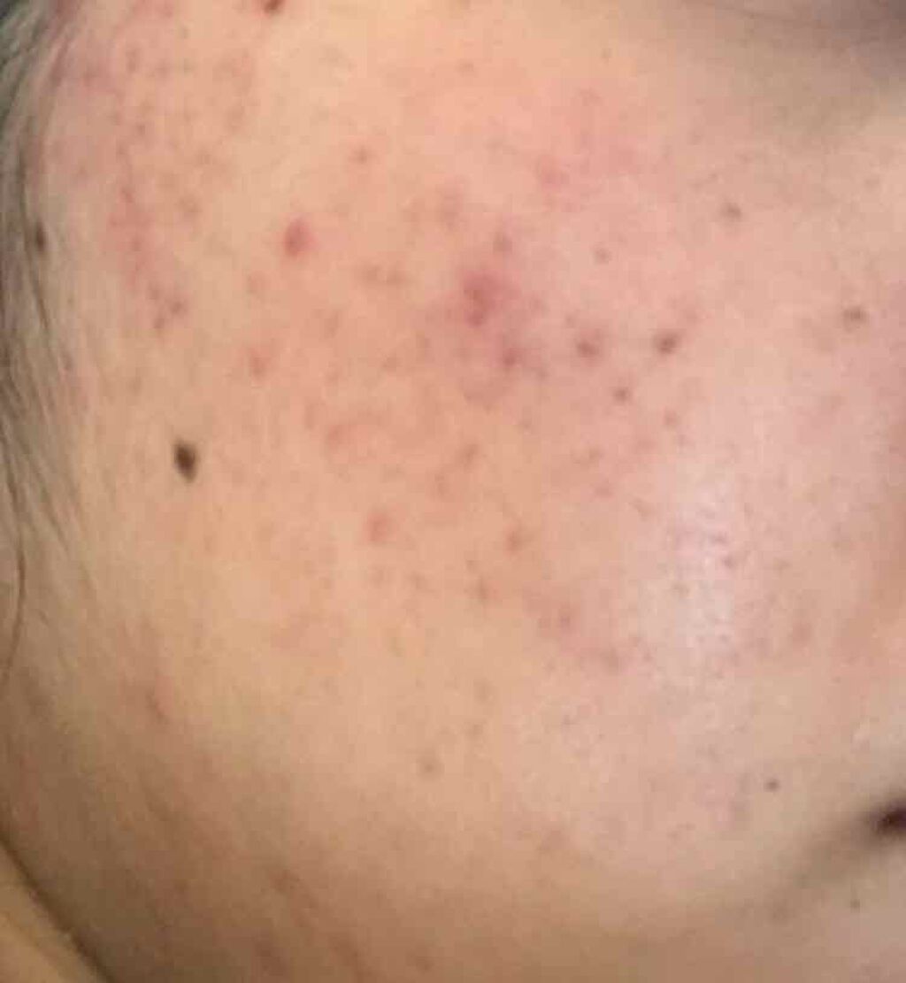 薬用保湿化粧水/オードムーゲ/化粧水を使ったクチコミ(4枚目)