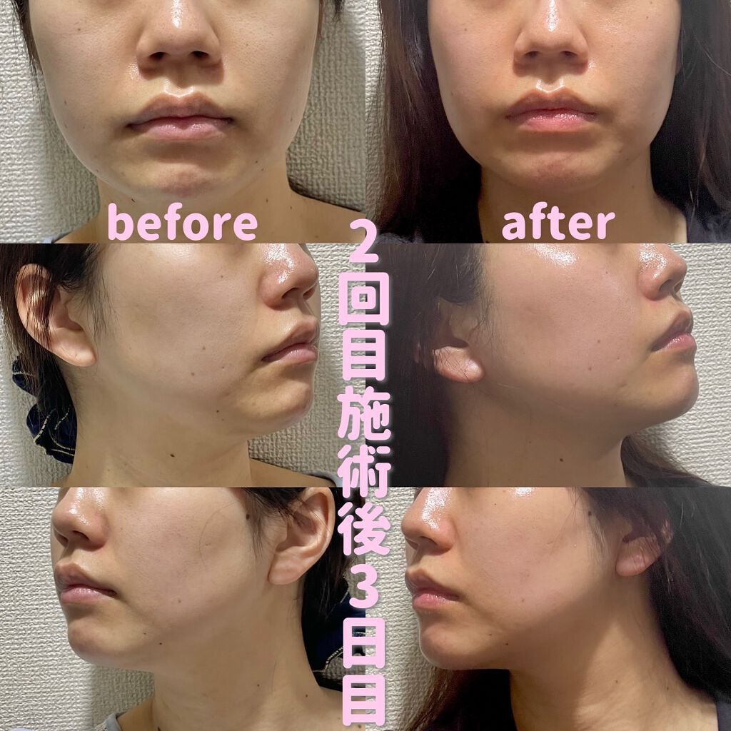 輪郭スッキリQ+/湘南美容/その他を使ったクチコミ（3枚目）