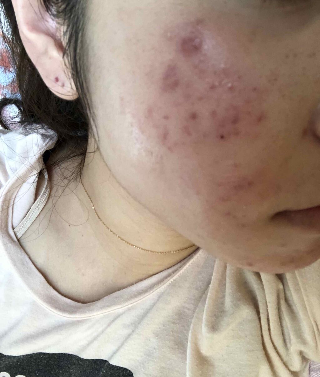 エピデュオゲル/マルホ株式会社/その他を使ったクチコミ（2枚目）