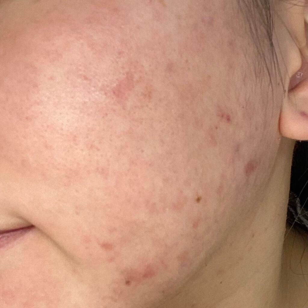 ぺんぎん on LIPS 「⚠️閲覧注意⚠️最近は新しいニキビができるのは減ってきました!..」(2枚目)