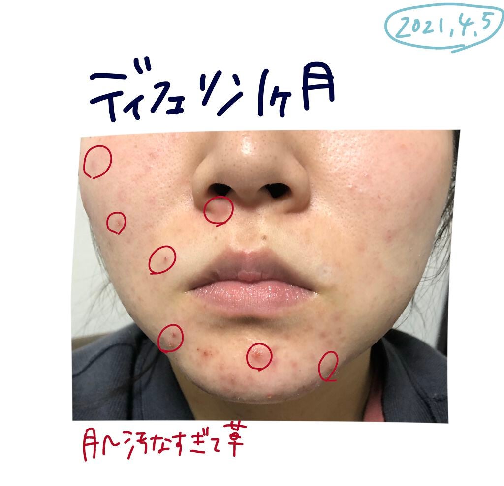 まるこ on LIPS 「※2枚目閲覧注意ディフェリン1ヶ月経ちました!継続してすごいわ..」(2枚目)