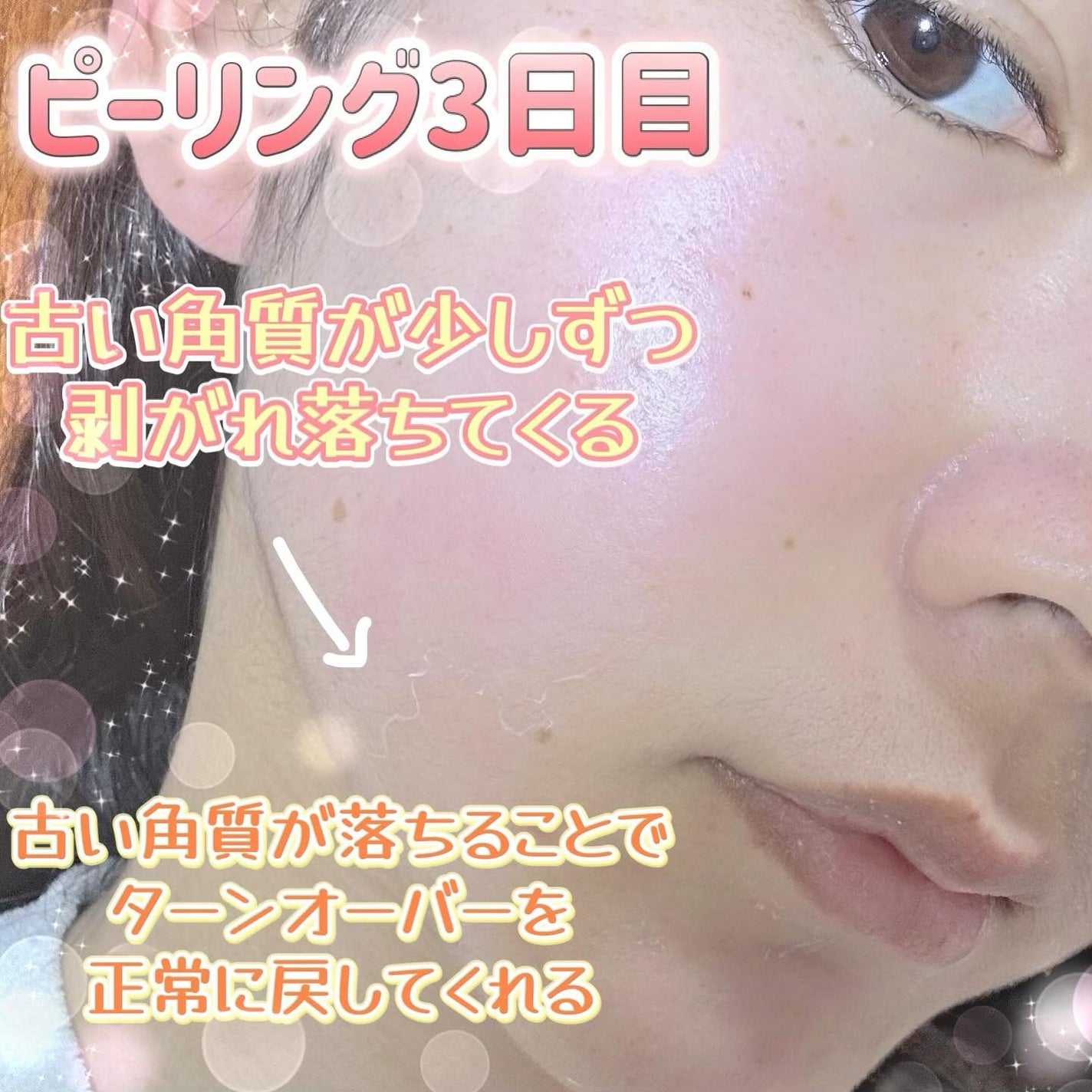 ダーマスキンピーリング/BQCELL/その他キットセットを使ったクチコミ(5枚目)