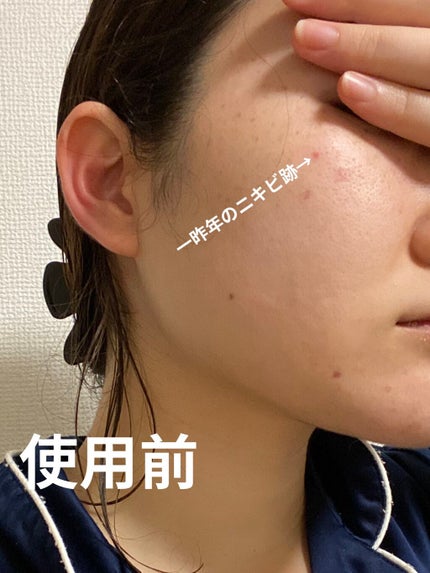 美白美容液 W/ちふれ/美容液を使ったクチコミ(2枚目)