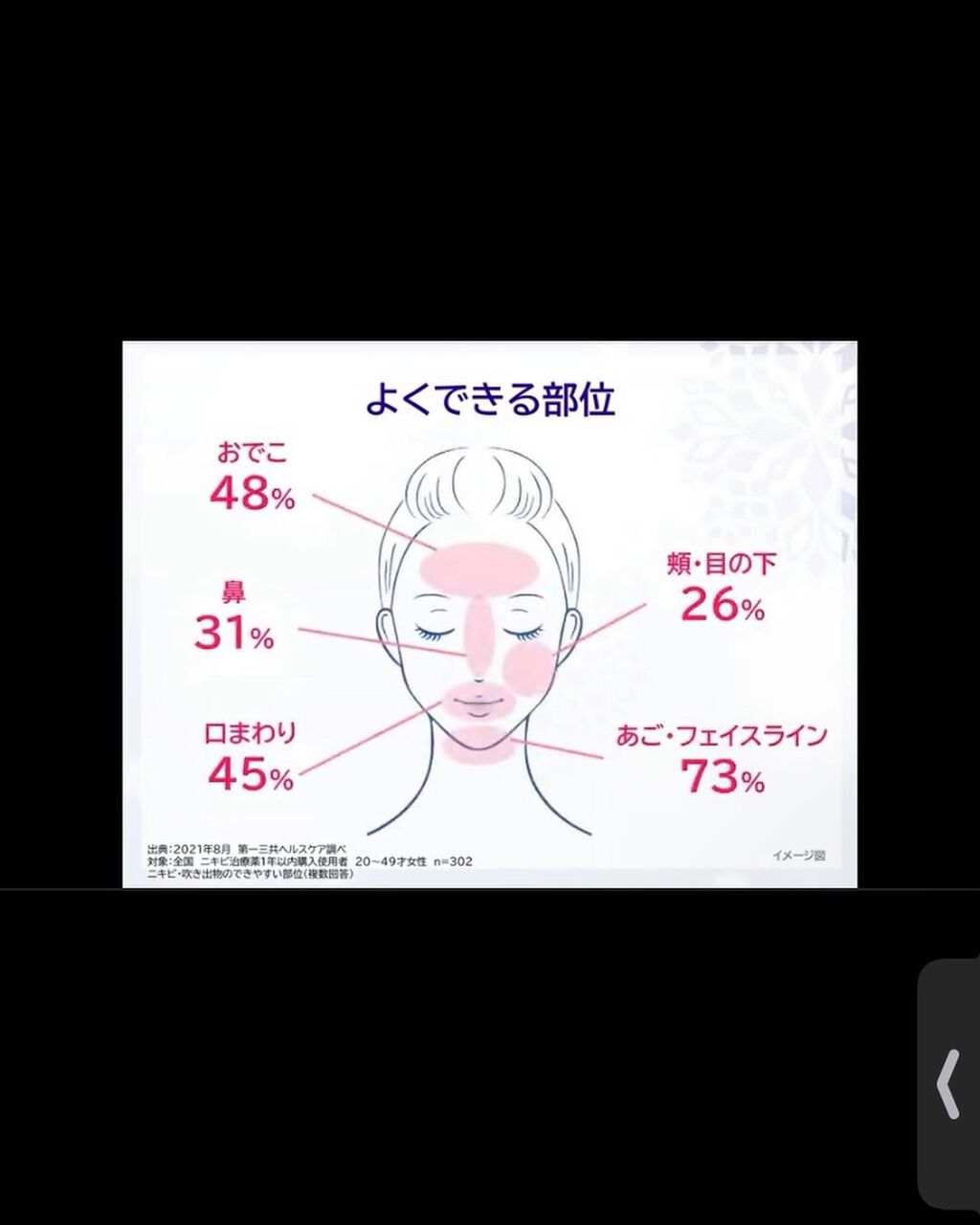 マキロン アクネージュ メディカルクリーム (医薬品) /マキロン/その他を使ったクチコミ(3枚目)