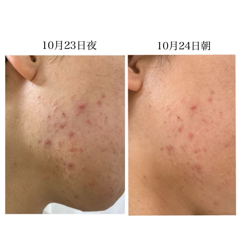 ペアアクネクリームW(医薬品)/ペア/その他を使ったクチコミ（2枚目）