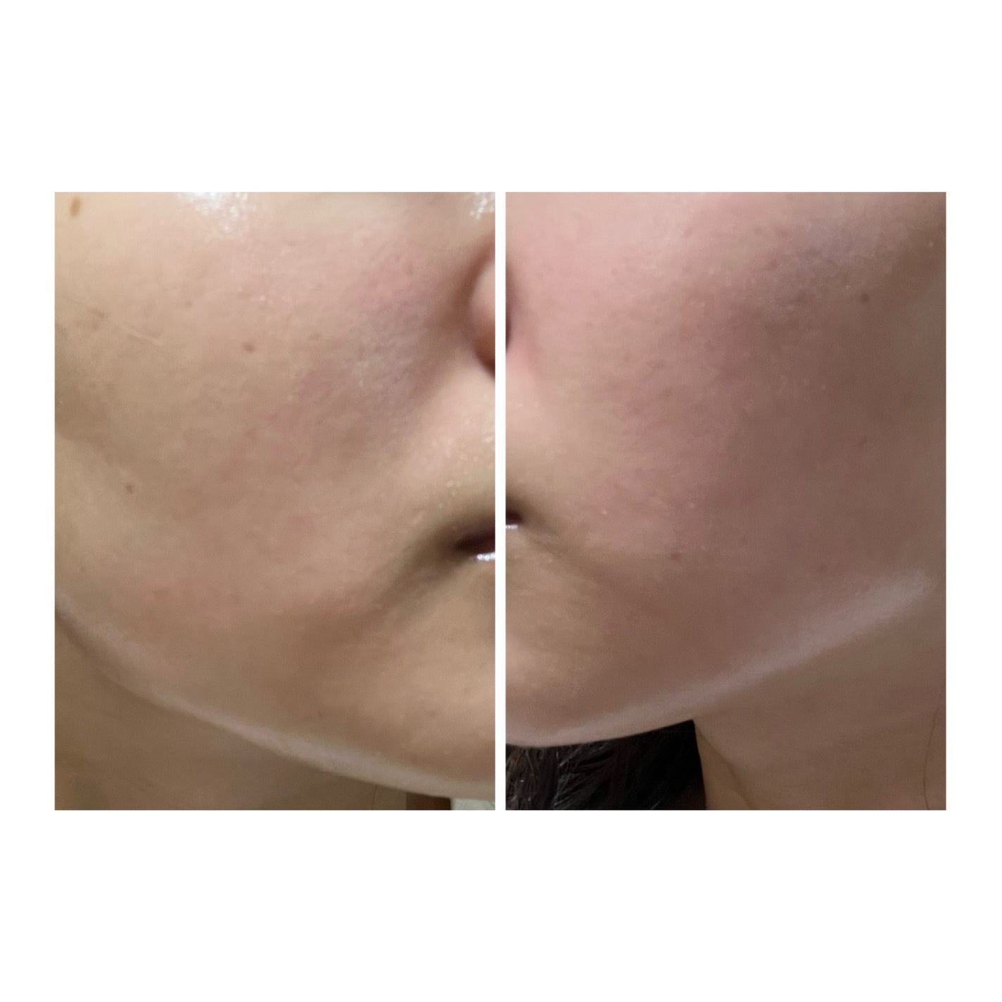 ぽむ on LIPS 「2023.9.13皮膚科に受診 エピデュオとヘパリン処方1枚目..」(5枚目)