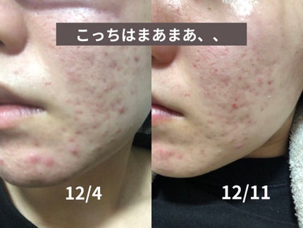 ロゼット洗顔パスタ アクネクリア/ロゼット/洗顔フォームを使ったクチコミ(3枚目)