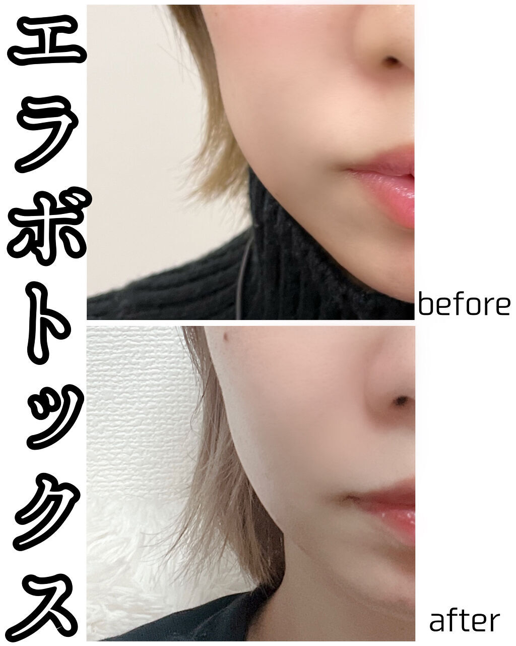 人生初エラボトックスやってきました👏
これまで顎と口角はやったことあったけどエラボトはまだ未経験で🤔
噛み締めや歯ぎしり防止にもいいと聞いて速攻トレビューでいつも行ってるクリニックを予約😊

両頬に1ccずつの計2ccでお値段2万円✌