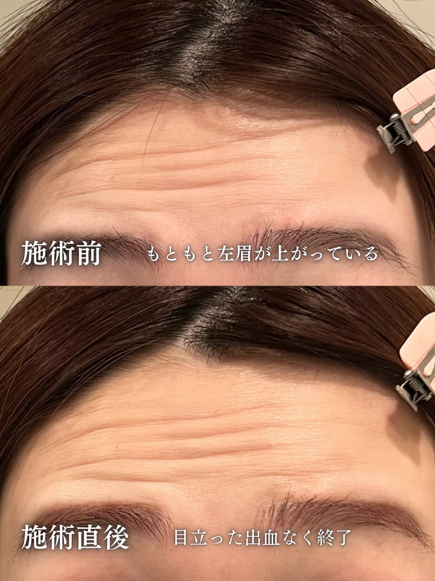 loco on LIPS 「\額ボト悩んでる人見て/これまで肌管理含め一切美容医療に手を出..」(3枚目)