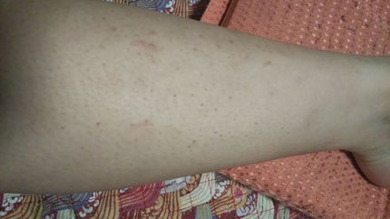 ゆん on LIPS 「私は中学一年生の時くらいに毛が気になり始めて、家にあったカミソ..」(2枚目)