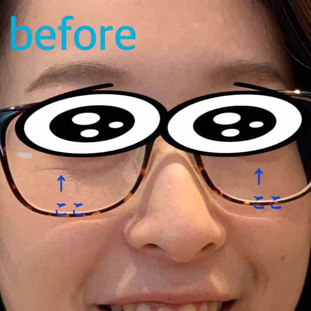 リンクルショット メディカル セラム/リンクルショット/アイケア・アイクリームを使ったクチコミ（2枚目）