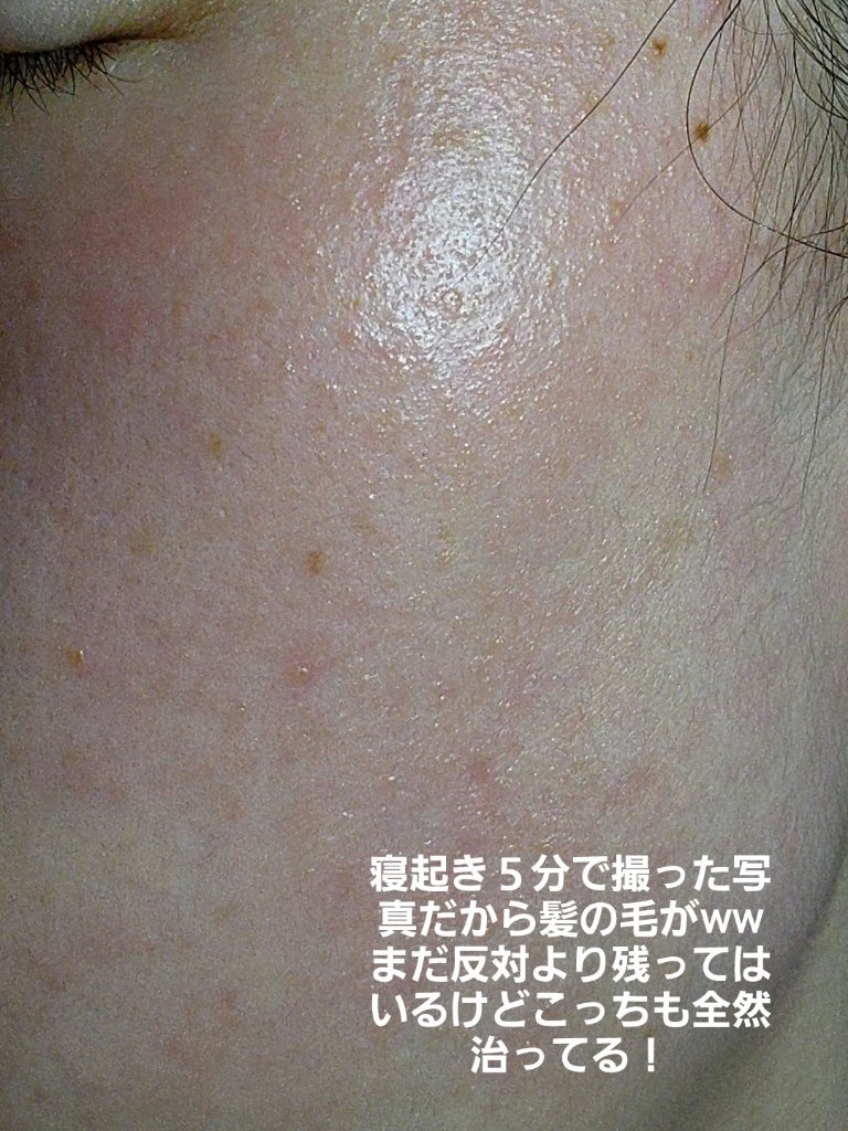 キュアレア（医薬品）/キュアレアa/その他を使ったクチコミ（3枚目）