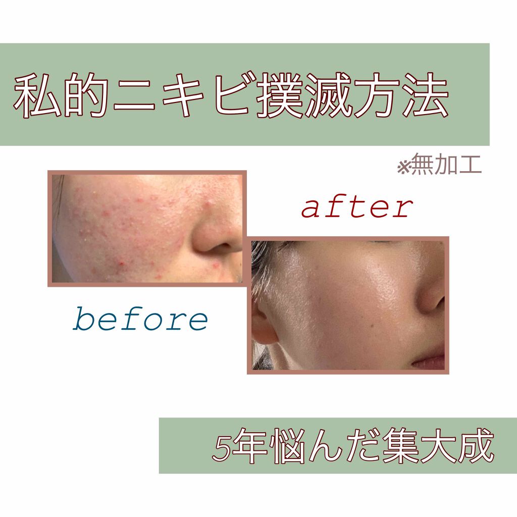 ユリ on LIPS 「✲*《私的ニキビ撲滅方法》*✲beforeは2017年7月、a..」(1枚目)