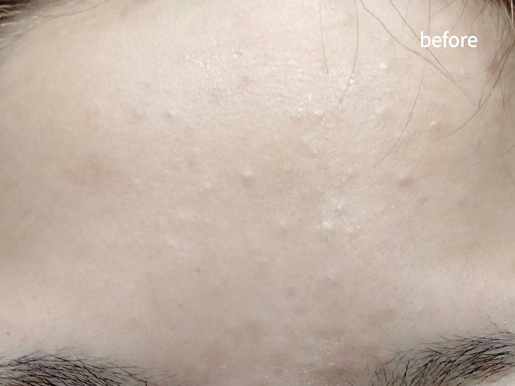 大人のニキビ対策 薬用美白化粧水/肌美精/化粧水を使ったクチコミ（2枚目）