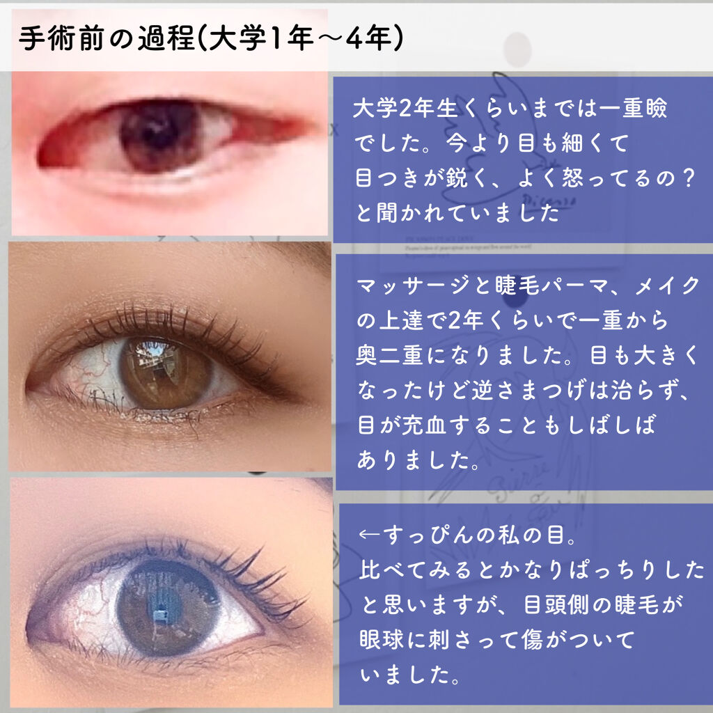 二重整形の口コミ 二重埋没 逆さまつげ手術について皆さんが気 By 紬 乾燥肌 代前半 Lips