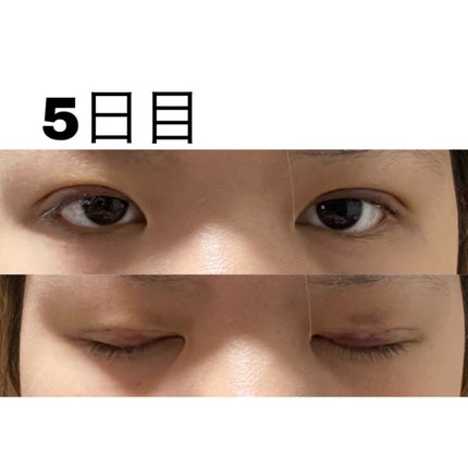 七瀬 on LIPS 「初投稿失礼します!この度ついに念願の二重埋没をしてきました〜!..」(7枚目)