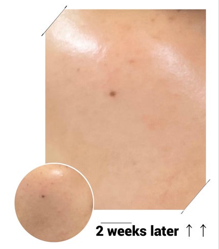 ビタペアC ビタレチ美容液/ネイチャーリパブリック/美容液を使ったクチコミ(5枚目)