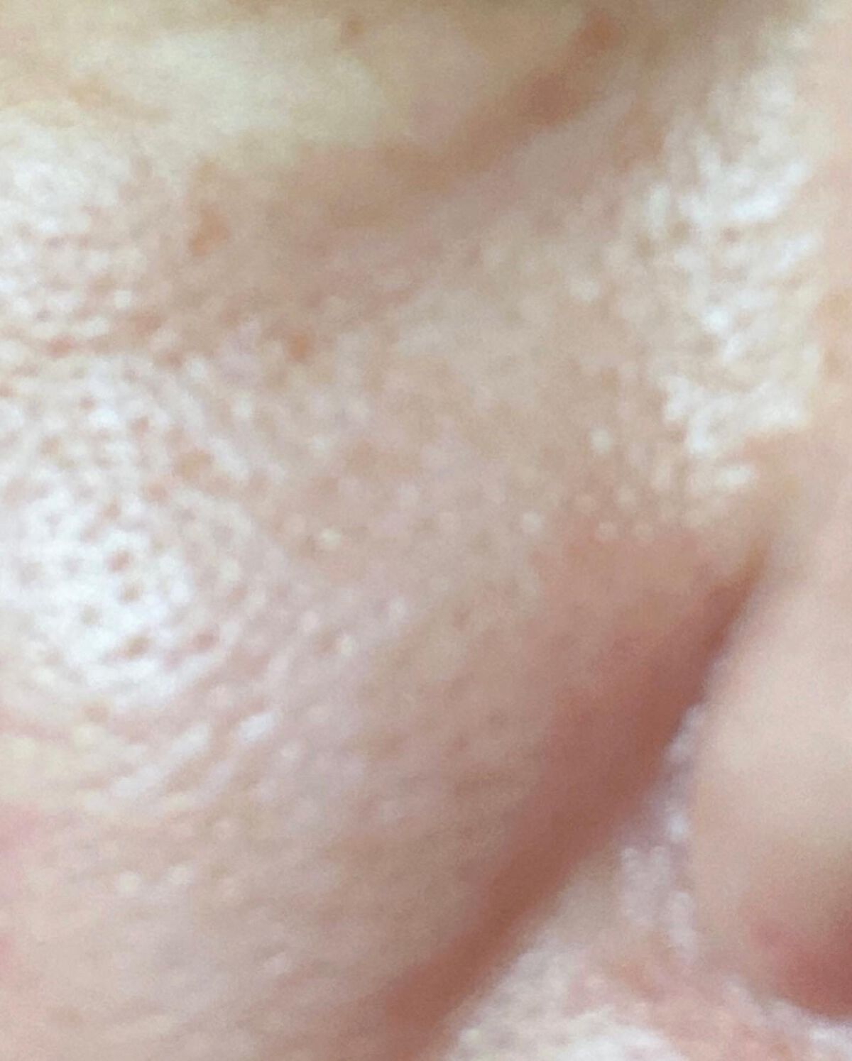 薬用アクネクリーム/NIKI PITA/フェイスクリームを使ったクチコミ(3枚目)