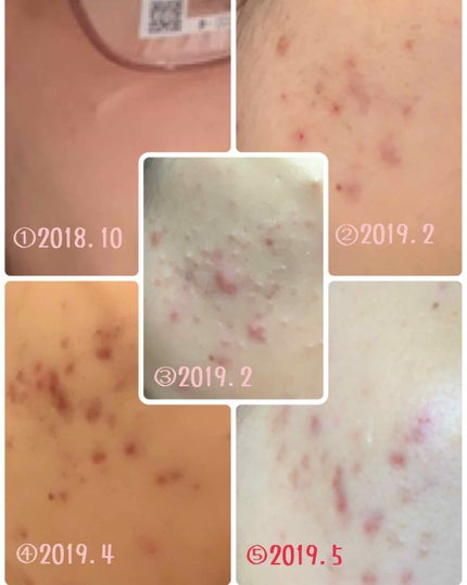 オードムーゲ 薬用ローション(ふきとり化粧水)/オードムーゲ/拭き取り化粧水を使ったクチコミ(3枚目)