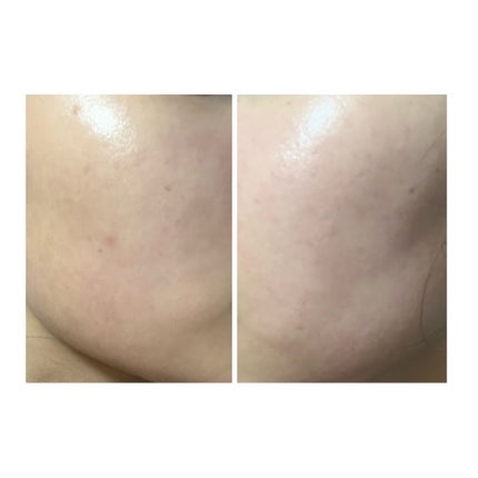 ぽむ on LIPS 「2023.9.13皮膚科に受診 エピデュオとヘパリン処方1枚目..」(4枚目)