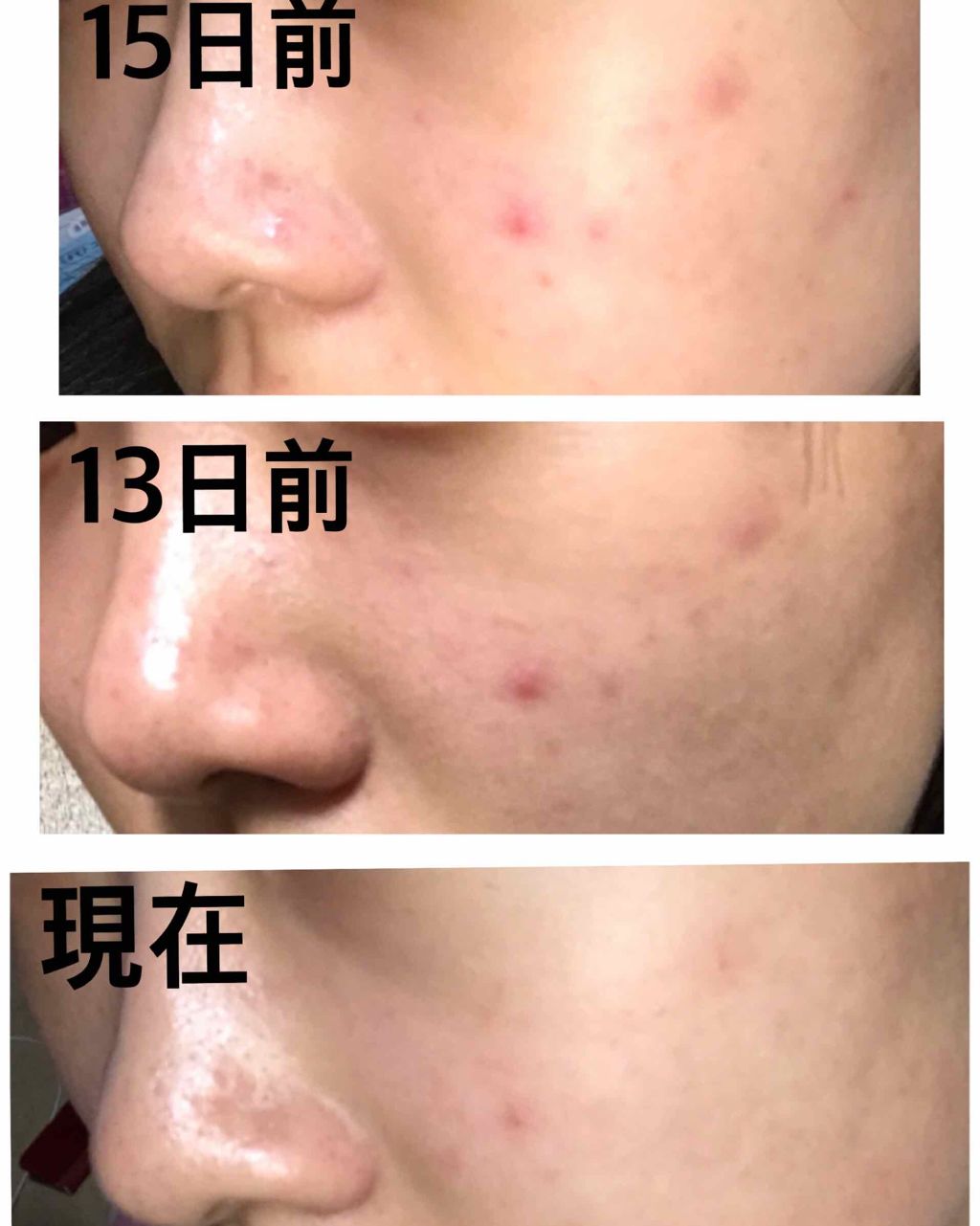 オロナインＨ軟膏 (医薬品)/オロナイン/その他を使ったクチコミ（3枚目）