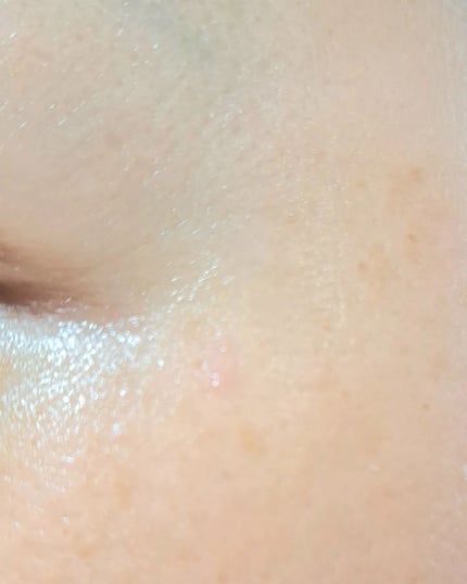 アンティア モイストバランサー/ドクターベルツ/化粧水を使ったクチコミ(6枚目)