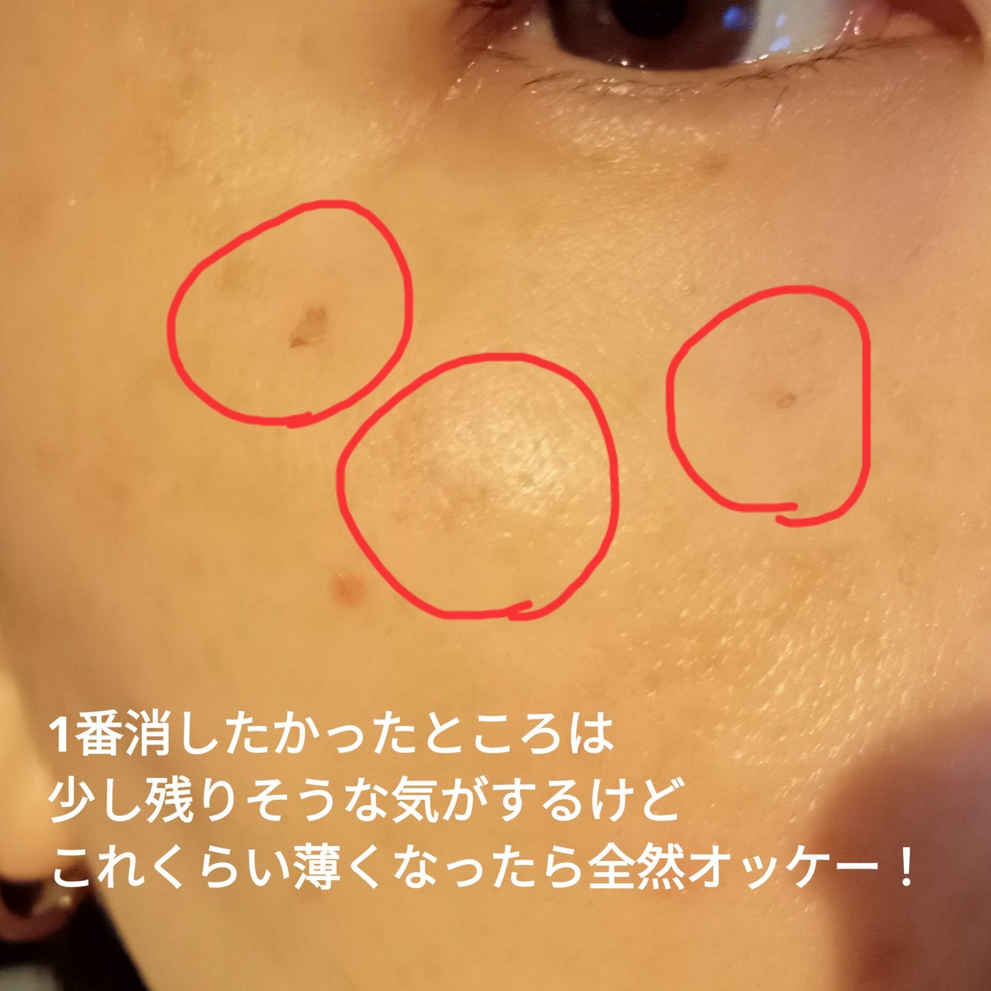 ビヨンセ奥二重向上委員長🥸LIPSパートナー🥳 on LIPS 「ついに!!この時が🤣🩷シミ取りレーザー全記録です🙌🙌🙌(五日目..」(10枚目)