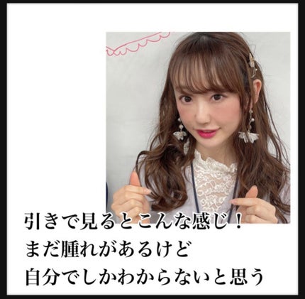 【旧】ディオールスキン フォーエヴァー スキン コレクト コンシーラー/Dior/リキッドコンシーラーを使ったクチコミ(5枚目)