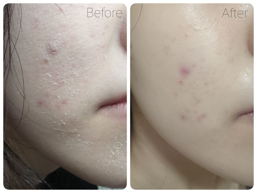 さいきa 保水治療ローション（医薬品）/Saiki/その他を使ったクチコミ（2枚目）