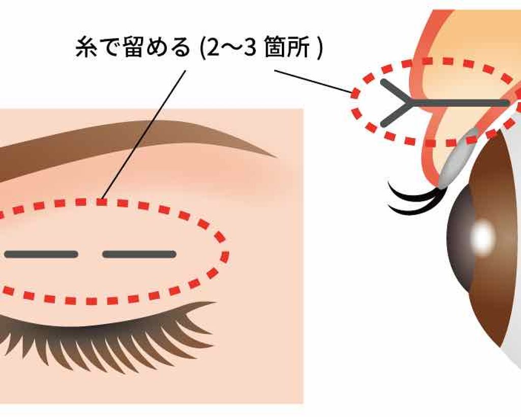 全顔コンプレックス女ちゃん👠 on LIPS 「埋没二重について🌙.*·̩͙切らずに施術時間15分ほどで簡単に..」(2枚目)