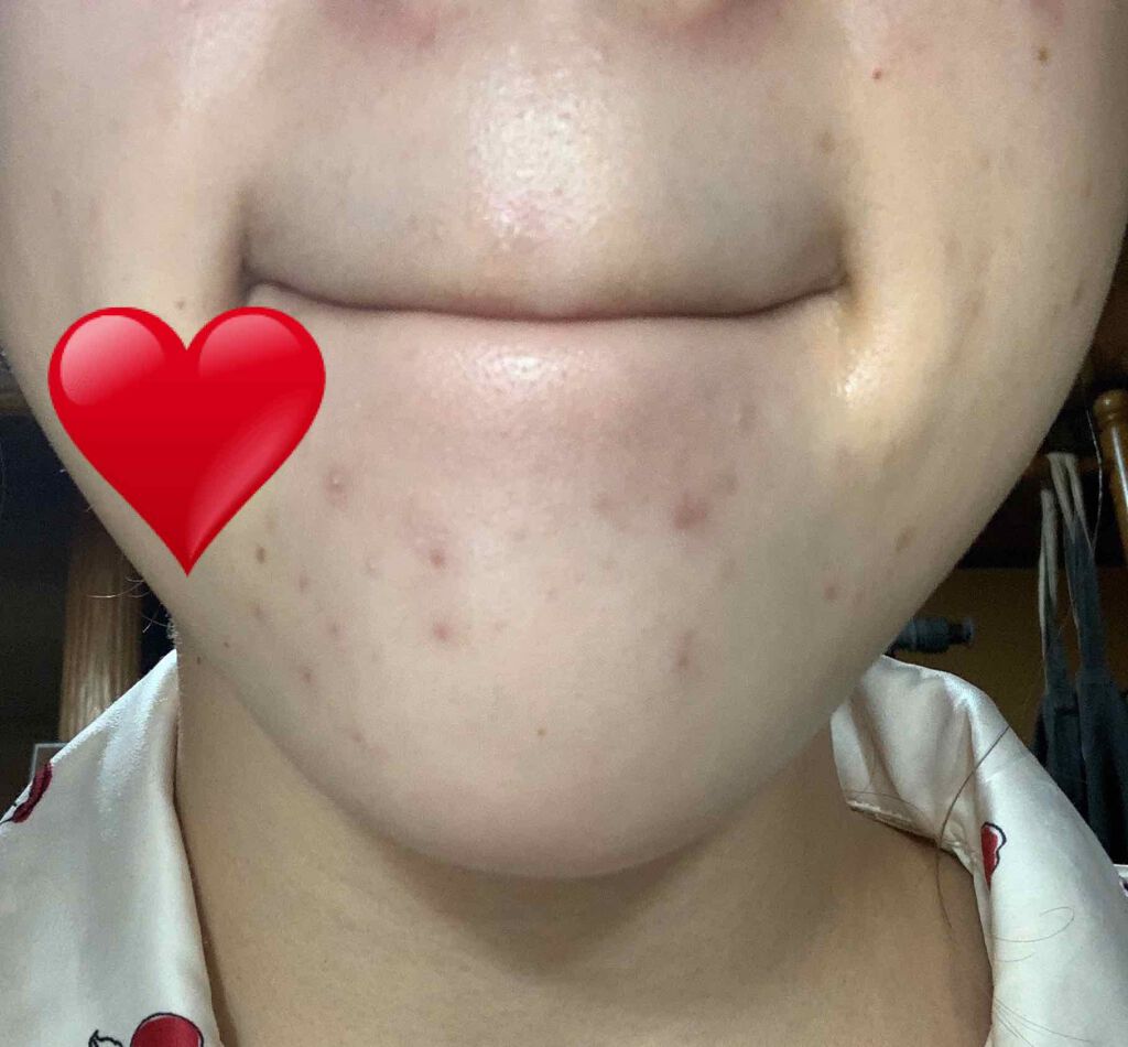 a on LIPS 「初投稿です!私は去年の11月ごろから突然大量の大人ニキビが発生..」(4枚目)