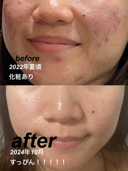 薬用 しみ 集中対策 美容液/メラノCC/美容液を使ったクチコミ(1枚目)
